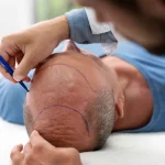 Diplomado en Transplante Capilar-1